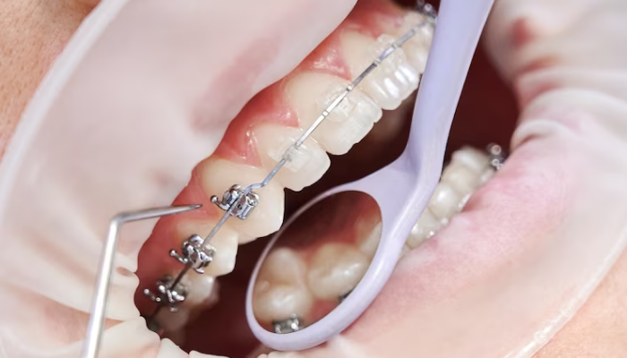 brackets metalicos Brackets Metálicos