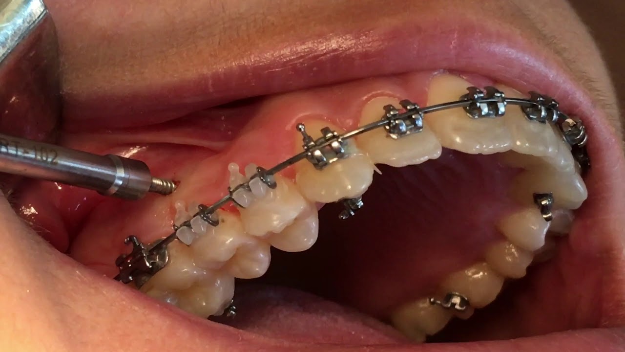 Microtornillos Brackets Autoligados