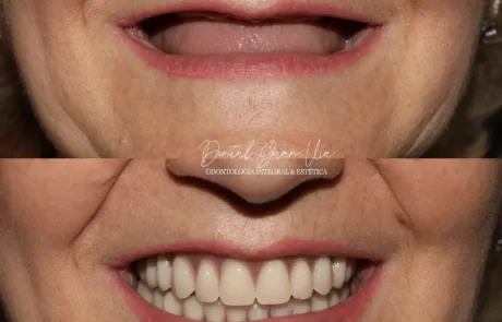 PROTESIS YREHABILITACION