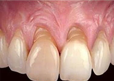 Recesiones gingivales antes