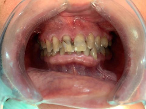 antes pepi 480x360 1