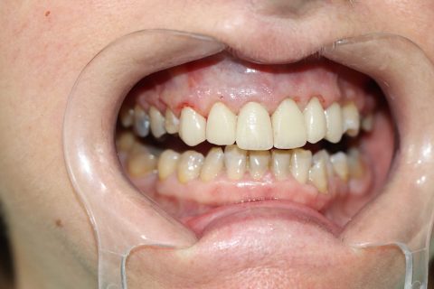 despues pepi 480x320 1