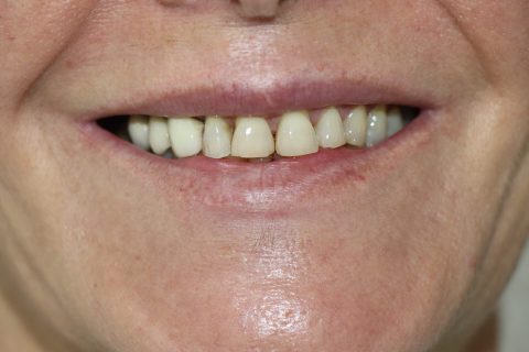 esther antes 1 480x320 1