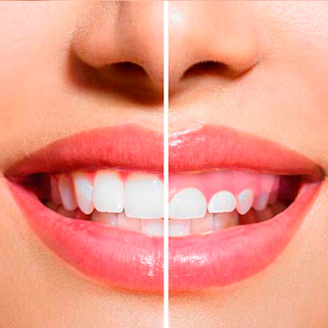 experiencia con gingivectomia Brackets Autoligados