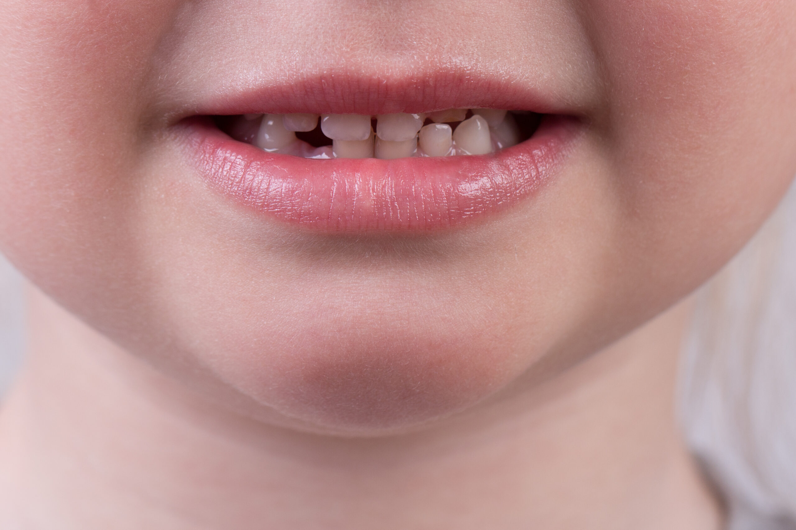 iStock 1125701035 scaled Brackets Autoligados