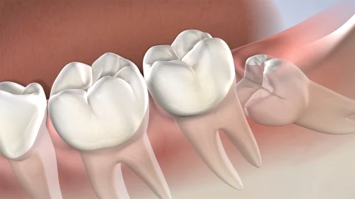 instructions wisdom teeth Brackets Autoligados