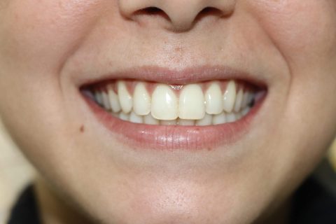 isa antes 1 480x320 1