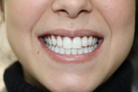 isa despues 1 480x320 1