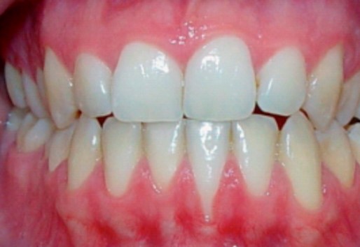 recesion gingival 600x300@2x.antes