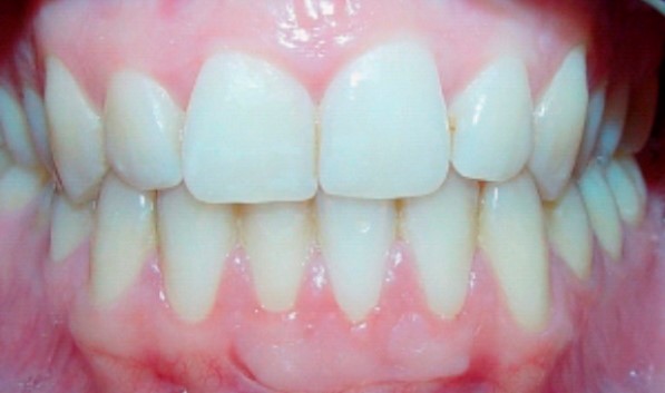 recesion gingival 600x300@2x.despues